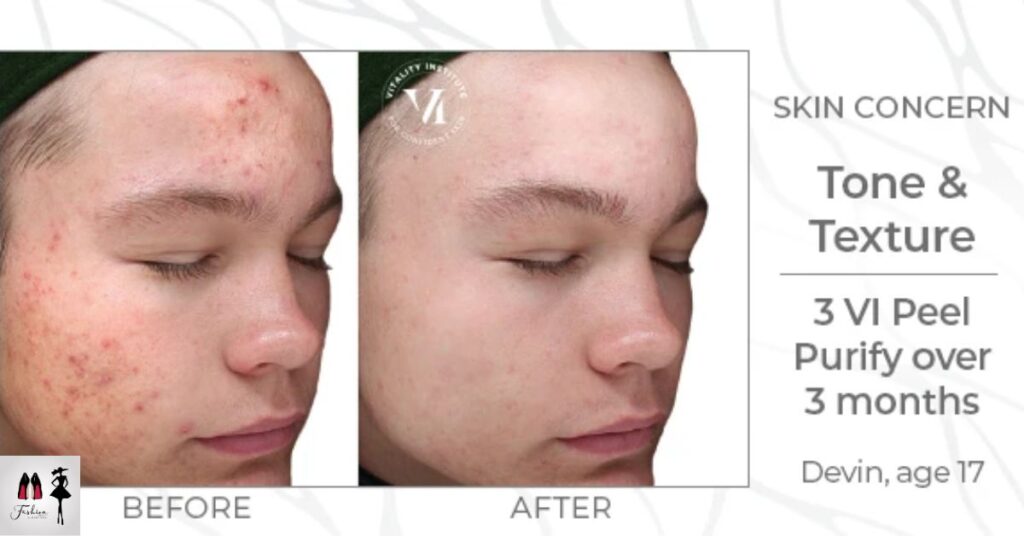 Treat Your Skin to All the Benefits of a Chemical Peel Without the Peeling